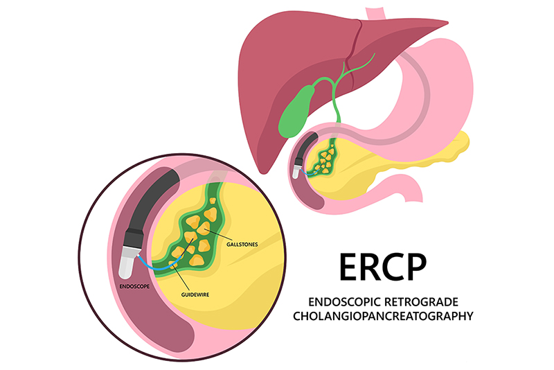 ERCP or endoscopic retrograde cholangiopancreatography